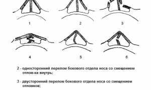 Лечебные меры и восстановление после перелома носа: советы и рекомендации