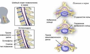 Лечение шейного остеохондроза при беременности: советы и рекомендации