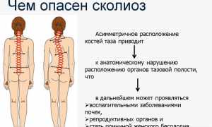 Когда можно получить инвалидность при сколиозе? Узнайте важные детали