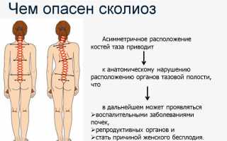 Когда можно получить инвалидность при сколиозе? Узнайте важные детали