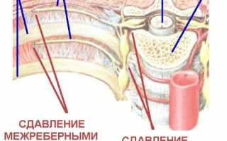 Как лечить межреберную невралгию при беременности? Полезные советы и рекомендации