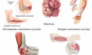 От чего может болеть локоть после тренировки? Причины и советы