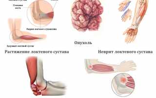 От чего может болеть локоть после тренировки? Причины и советы