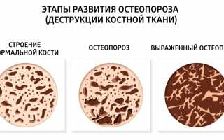 Степени инвалидности при остеопорозе: важные аспекты и рекомендации