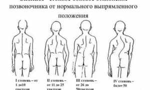 Проявление юношеского идиопатического сколиоза: причины и симптомы