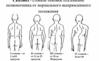 Проявление юношеского идиопатического сколиоза: причины и симптомы