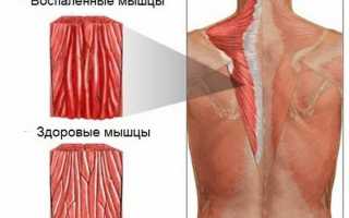 Каковы причины появления онемения в области спины? Узнайте больше о симптомах