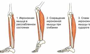 Первая помощь и лечение при мышечных судорогах: советы и рекомендации