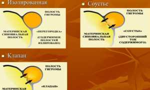 Причины возникновения гигромы и методы ее лечения: важные аспекты