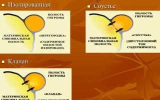 Причины возникновения гигромы и методы ее лечения: важные аспекты
