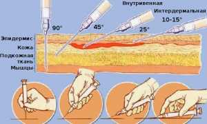 Как нужно применять уколы препарата Вольтарен для эффективного лечения?