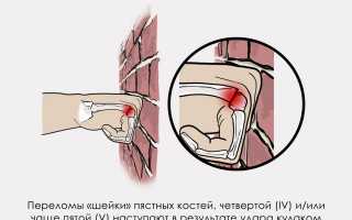 Типы перелома пястной кости и методы лечения в травматологии