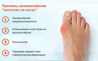 Какой врач лечит деформацию в виде косточки на пальце ноги? Узнайте подробности
