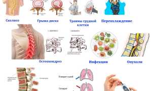 Симптомы межреберной невралгии и методы ее лечения: полезная информация для пациентов