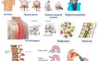 Симптомы межреберной невралгии и методы ее лечения: полезная информация для пациентов
