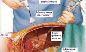 Когда нужно делать операцию при кисте яичника? Важные рекомендации