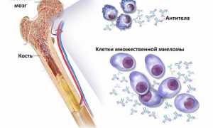 Что такое диффузный остеопороз? Обзор и причины