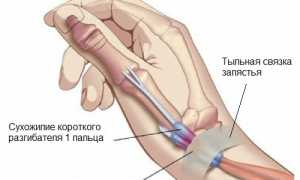 Что такое гигрома запястья и как от нее избавиться? Полезные советы.