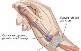 Что такое гигрома запястья и как от нее избавиться? Полезные советы.