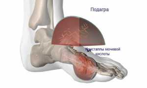 Можно ли есть лук и чеснок при подагре? Узнайте мнение врачей