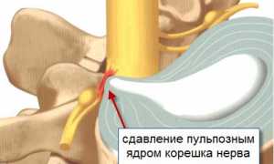 Лечебная гимнастика при межреберной невралгии для улучшения состояния