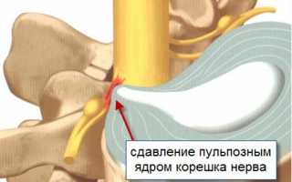Лечебная гимнастика при межреберной невралгии для улучшения состояния