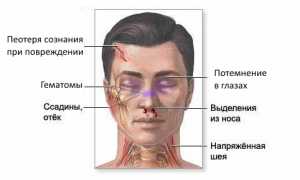 Оказание первой помощи и лечение при ушибе носа: советы и рекомендации