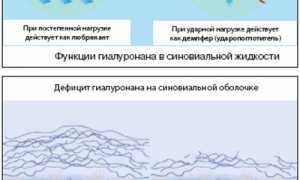 Аналоги протеза синовиальной жидкости Синокром для лечения суставов