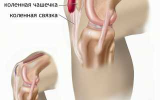 Что такое супрапателлярный бурсит коленного сустава и его лечение?