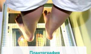 С какой степенью плоскостопия не берут в армию? Полное руководство