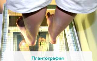 С какой степенью плоскостопия не берут в армию? Полное руководство