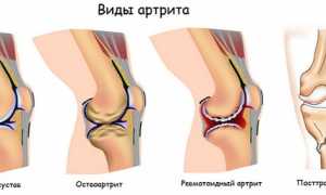 Причины возникновения и лечение артрита у детей: важные аспекты