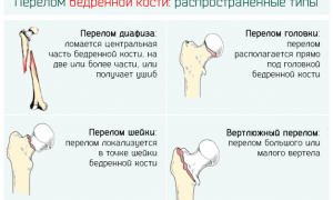 Какие бывают виды переломов бедра и как их лечить правильно?