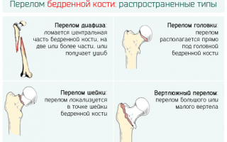Какие бывают виды переломов бедра и как их лечить правильно?