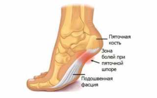 Лечение артроза суставов стопы: эффективные методы и рекомендации
