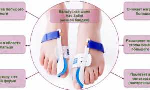 Применение ночного фиксатора Hav Splint при вальгусной стопе для улучшения здоровья