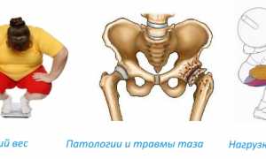 Что такое остеосклероз и как лечить уплотнение костей? Полное руководство