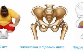 Что такое остеосклероз и как лечить уплотнение костей? Полное руководство