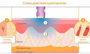 Использование холода в целях лечения суставов и улучшения здоровья