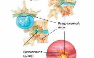 Занятия бегом при межпозвоночной поясничной грыже: советы и рекомендации