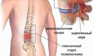 Эффективность лечения межпозвоночной грыжи пиявками: научные исследования и практические рекомендации
