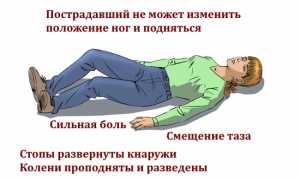 Восстановление после перелома седалищной кости: советы и рекомендации