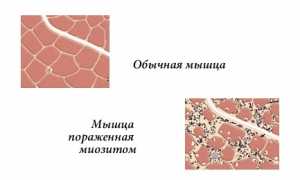 Как определить и чем лечить миозит мышц ног? Полезные советы