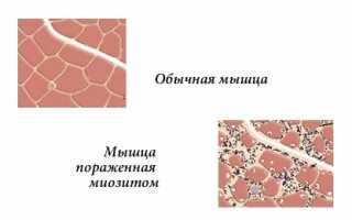 Что приводит к миозиту межреберных мышц и как его лечить? Полезные советы и рекомендации