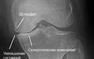 Правосторонний и левосторонний гонартроз 2 степени: причины и лечение