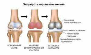 Осуществляем выбор эндопротеза коленного сустава для успешного восстановления