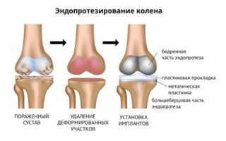 Осуществляем выбор эндопротеза коленного сустава для успешного восстановления
