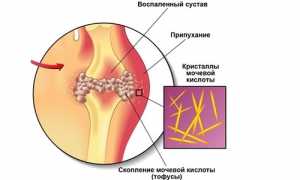 Лечебная физкультура и гимнастика при подагре для улучшения здоровья