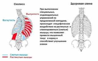Лечение сколиоза с помощью мануальной терапии для улучшения здоровья