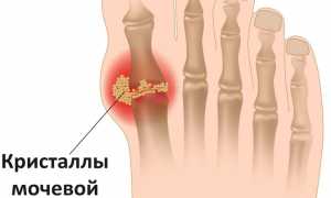 Эффективные способы лечения подагры пищевой содой в домашних условиях